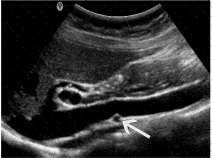 AB-Abdomen Question 21