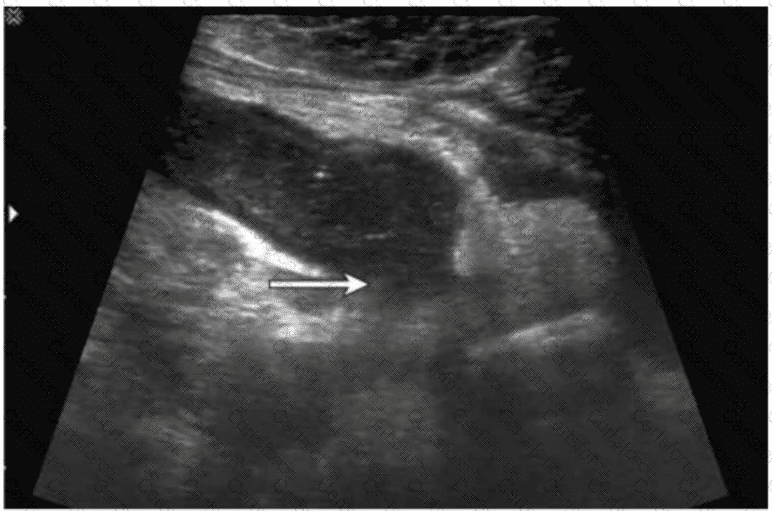 AB-Abdomen Question 20